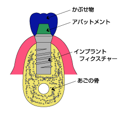 インプラント治療とは?