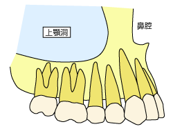 サイナスリフト1
