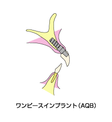 ワンピースインプラント(AQB)