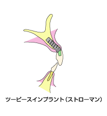 ツーピースインプラント(ストローマン)