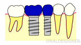 インプラント治療