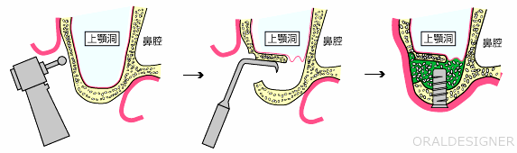 サイナスリフトの術式