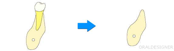 Guided Bone Regeneration