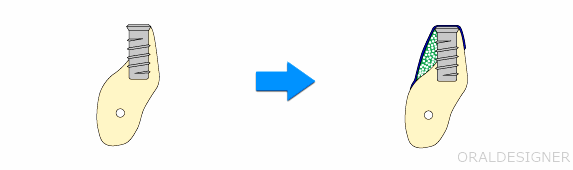 Guided Bone Regeneration