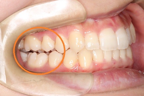 インビザラインの弱点とは 矯正歯科医が教える７つのデメリット オーラルデザイナー新宿デンタルクリニック