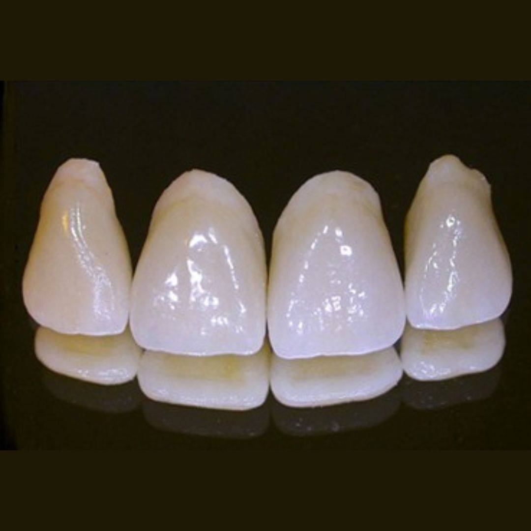 ジルコニア冠（グラデーション）