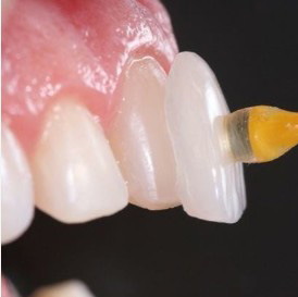 ラミネートべニア