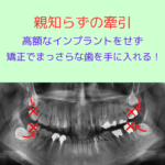 矯正治療で親知らずを引っ張り出して高額なインプラントを避ける！