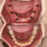 （症例）下顎全顎インプラントブリッジ※外科時画像あり