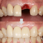 （症例）前歯部インプラントおよび外側性骨造成（GBR)※外科時画像あり