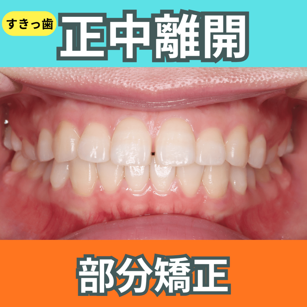 部分矯正（その２・すきっ歯）