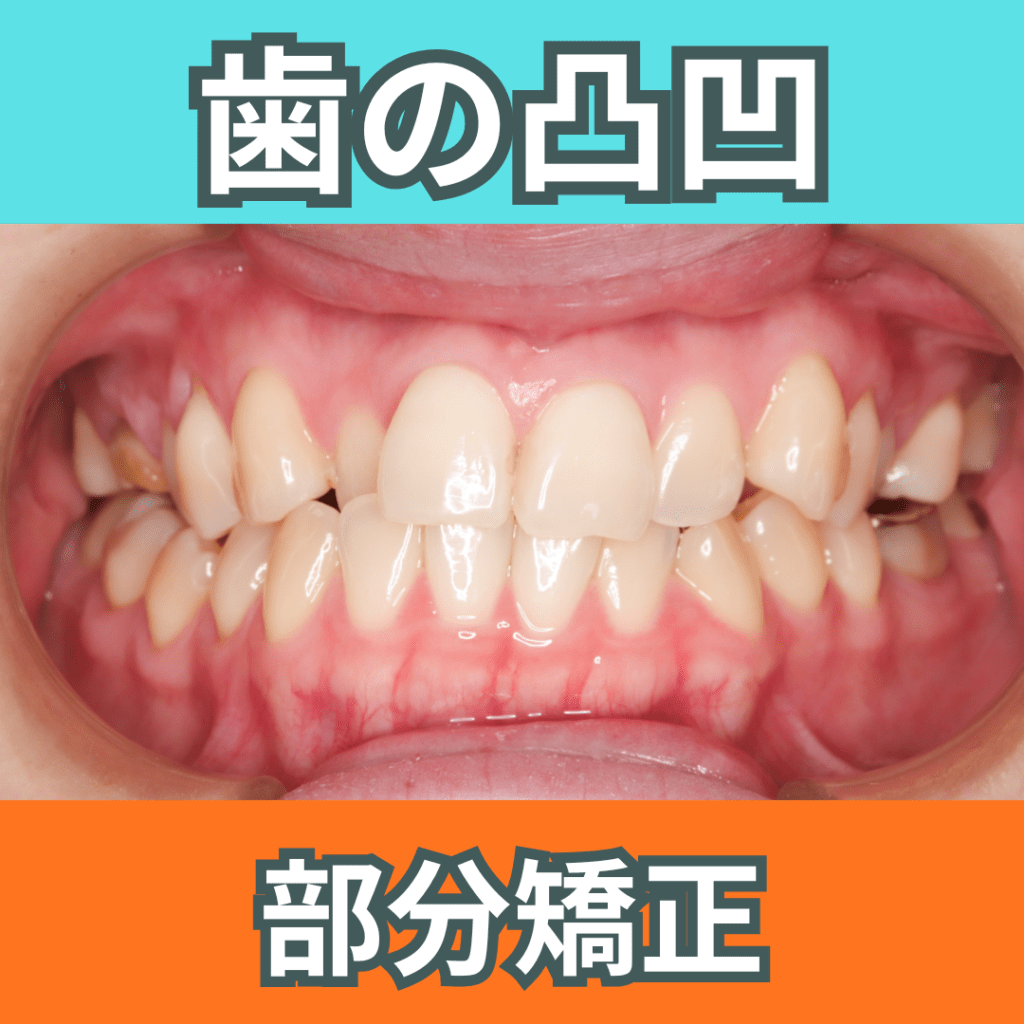 部分矯正（その１・前歯クロスバイト）