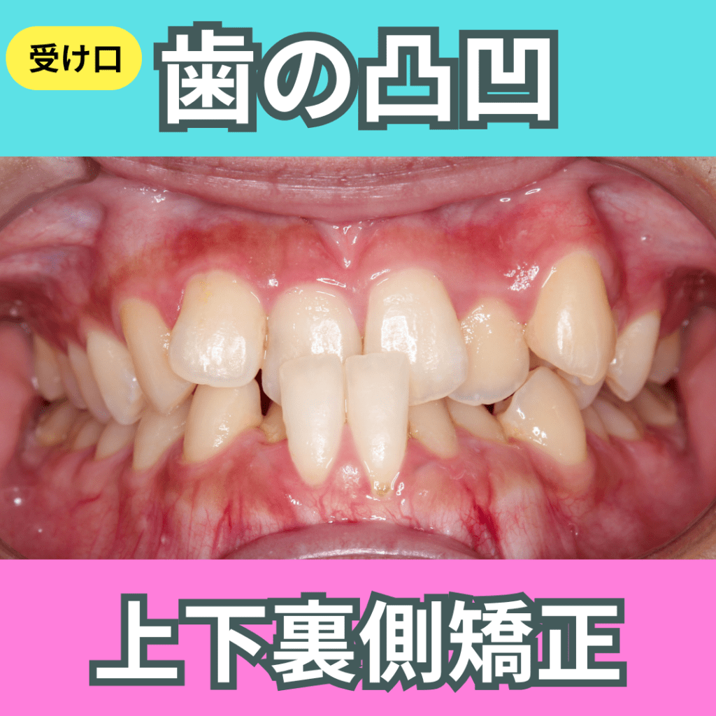 上下顎裏側矯正（その２・受け口・歯の凸凹）