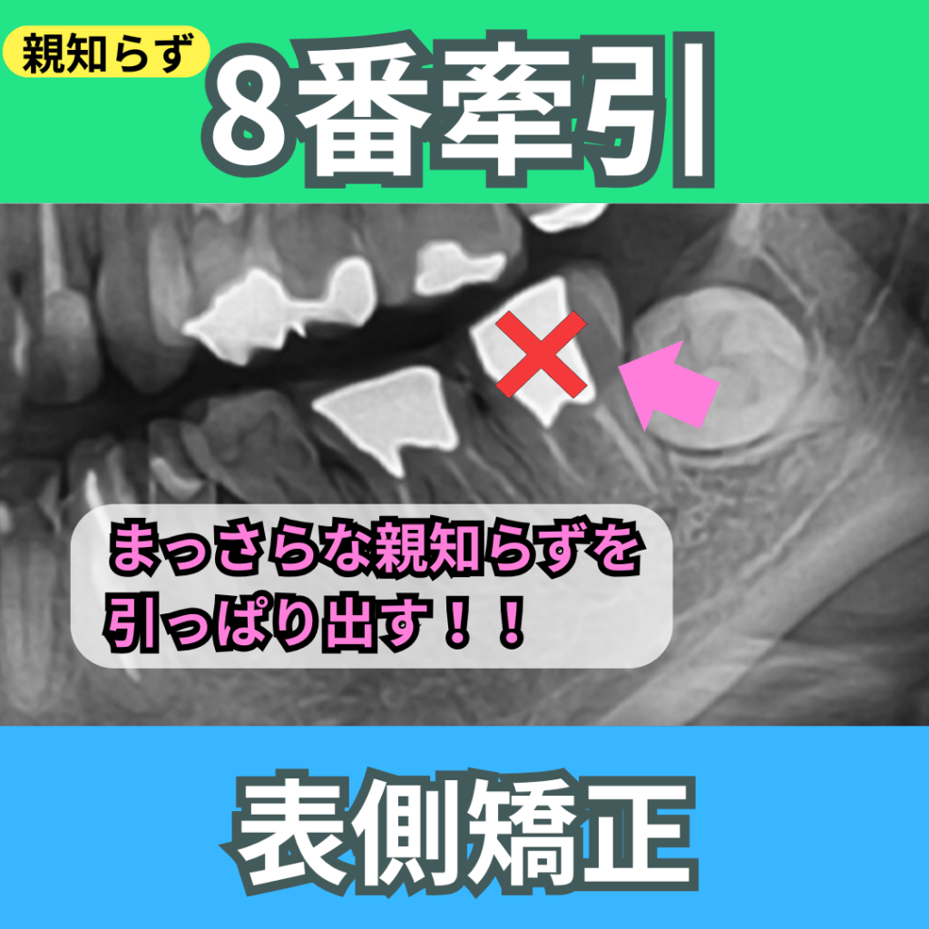 ８番（親知らず）牽引（その１）