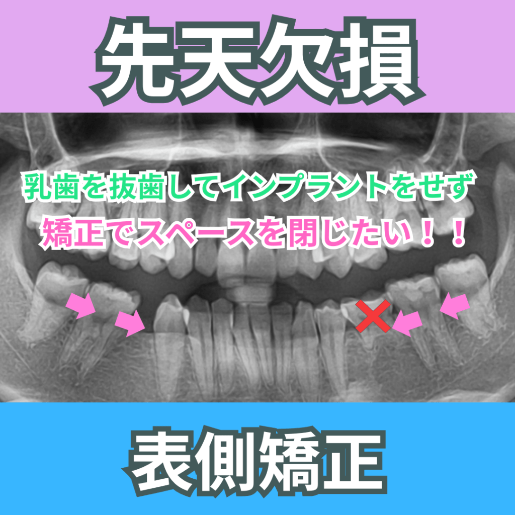 先天欠損（矯正でスペースを閉じる）