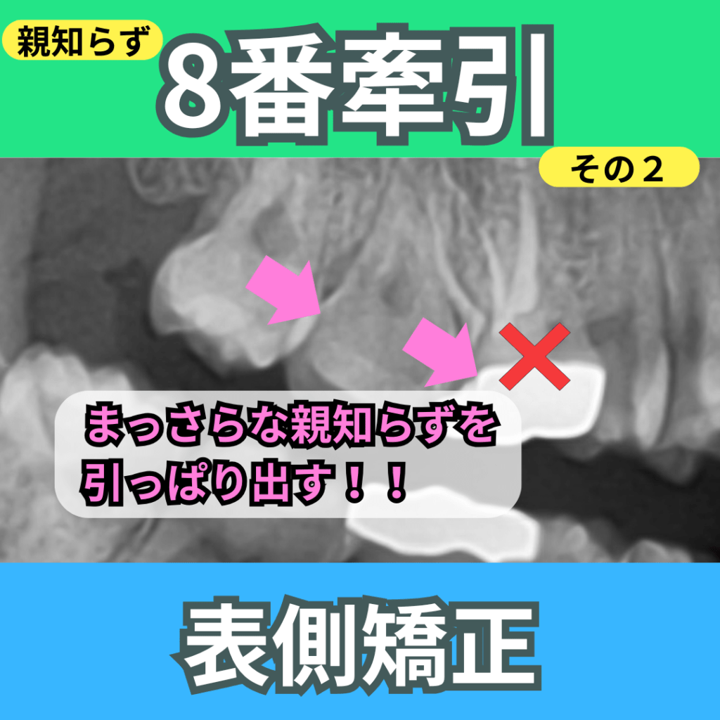 8番（親知らず）の牽引（その２）