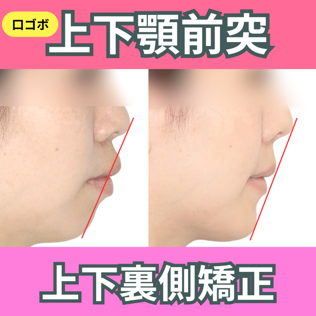 上下顎裏側矯正（その１・上下顎前突・口ゴボ）