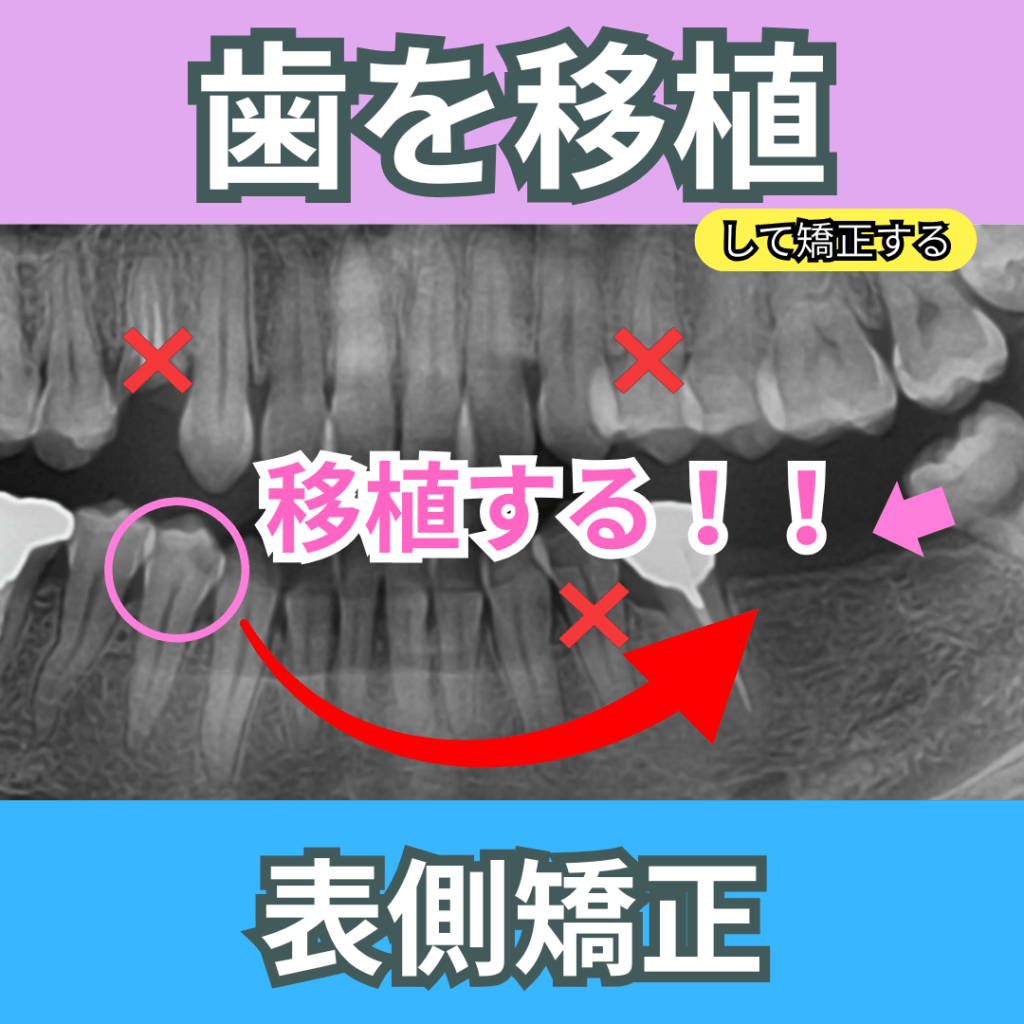 抜いた歯を再利用（移植）して矯正する