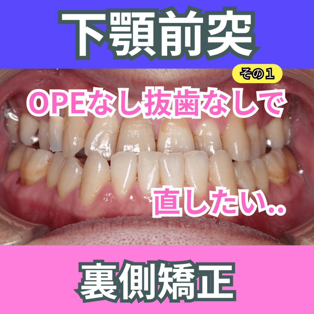 下顎前突（受け口）