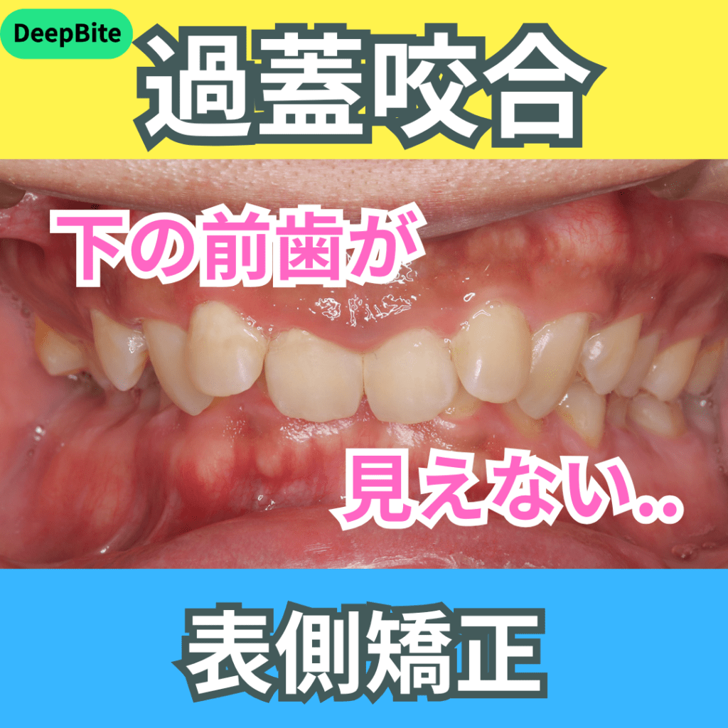 DeepBite（過蓋咬合）