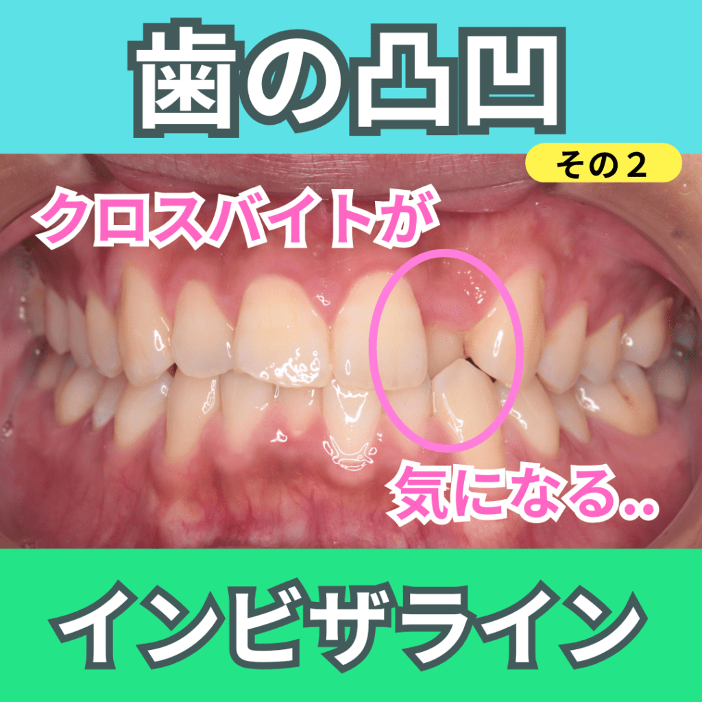 叢生（そうせい：凸凹）