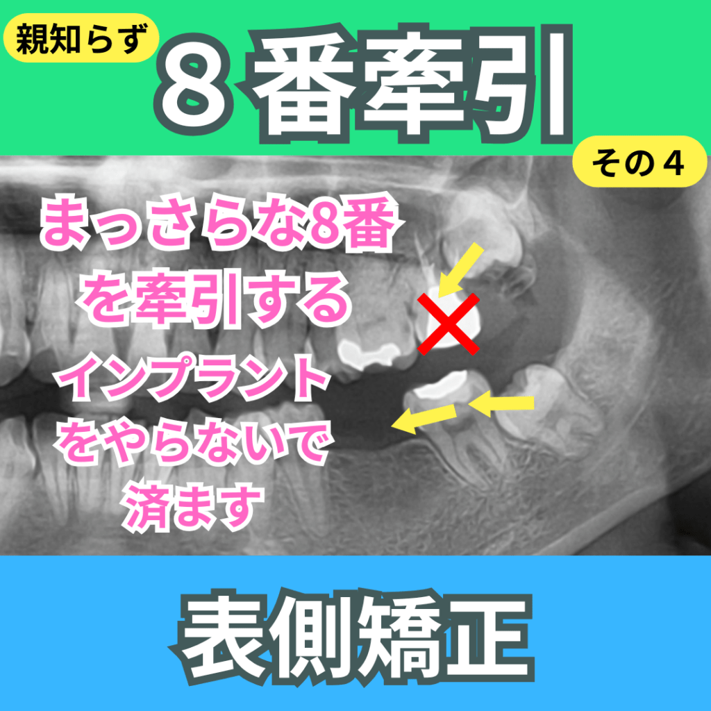 8番（親知らず）の牽引（その４）