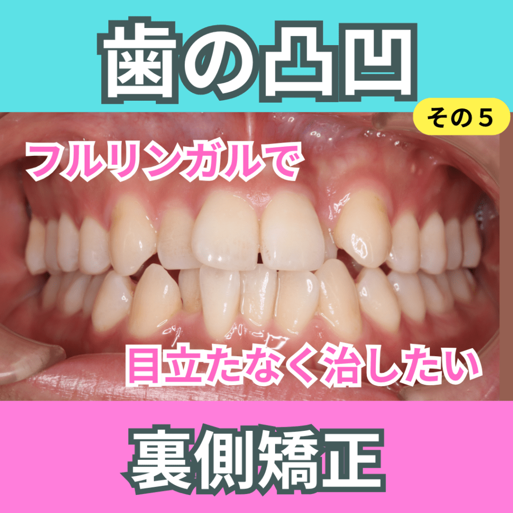 叢生（そうせい：歯の凸凹）その５