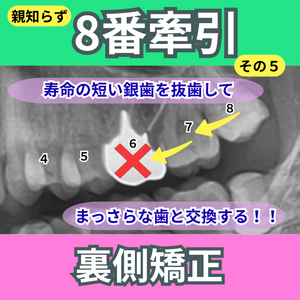 8番（親知らず）牽引（その５）