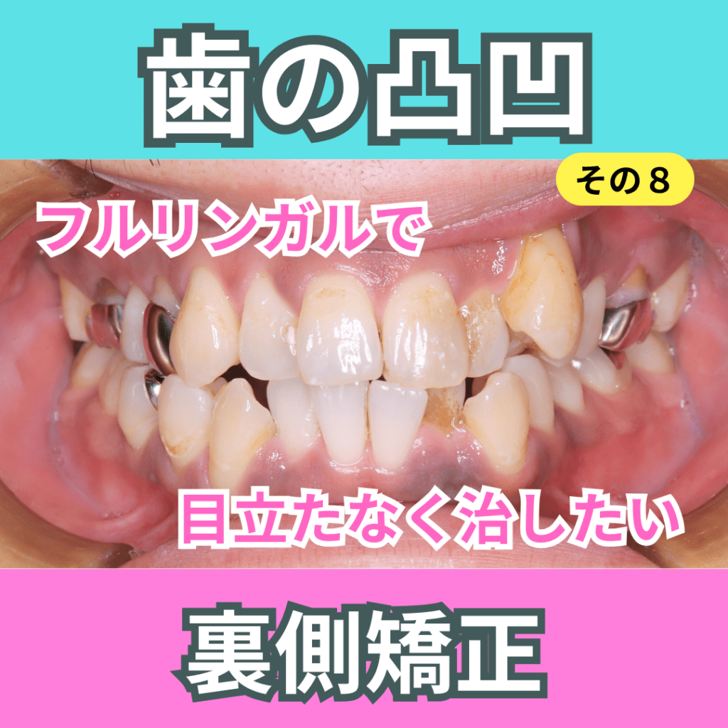 叢生8（上下裏側矯正）